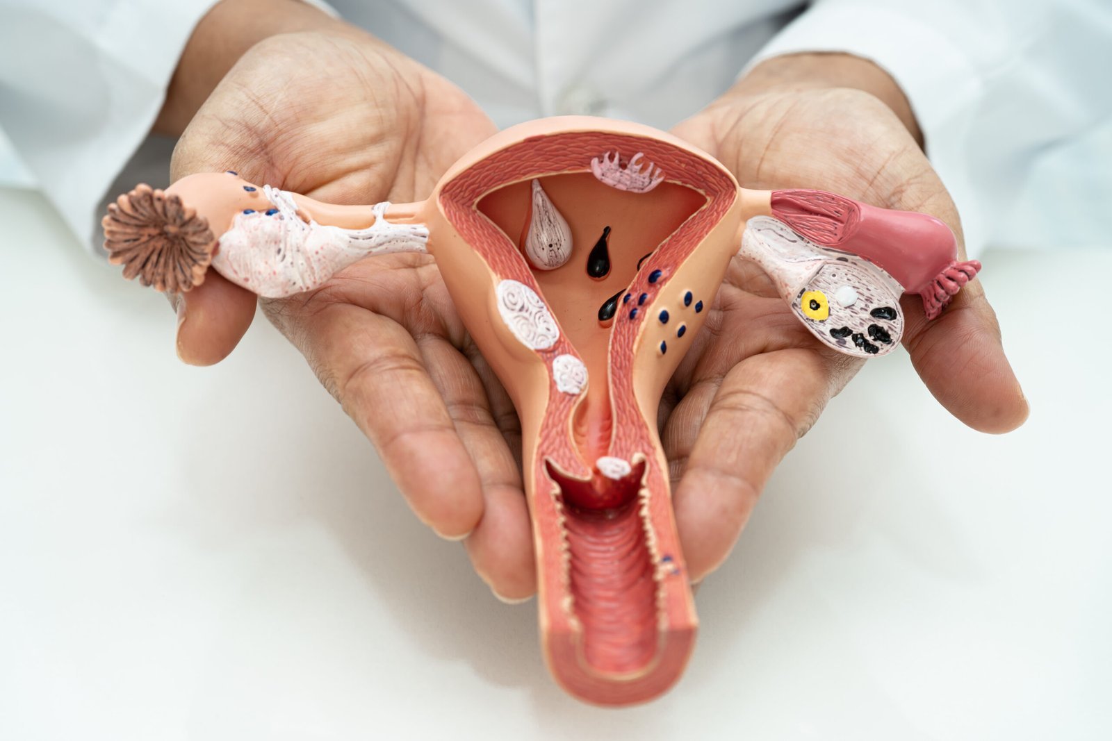 CÁNCER GINECOLÓGICO HEREDITARIO